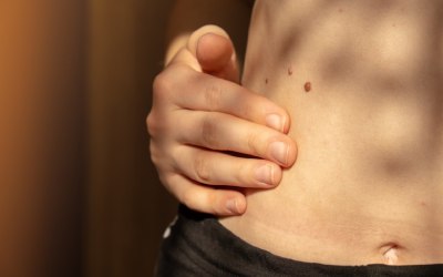 Dark Spots: Causes & Types 