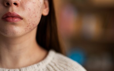 Dark Spots: Effective Treatments