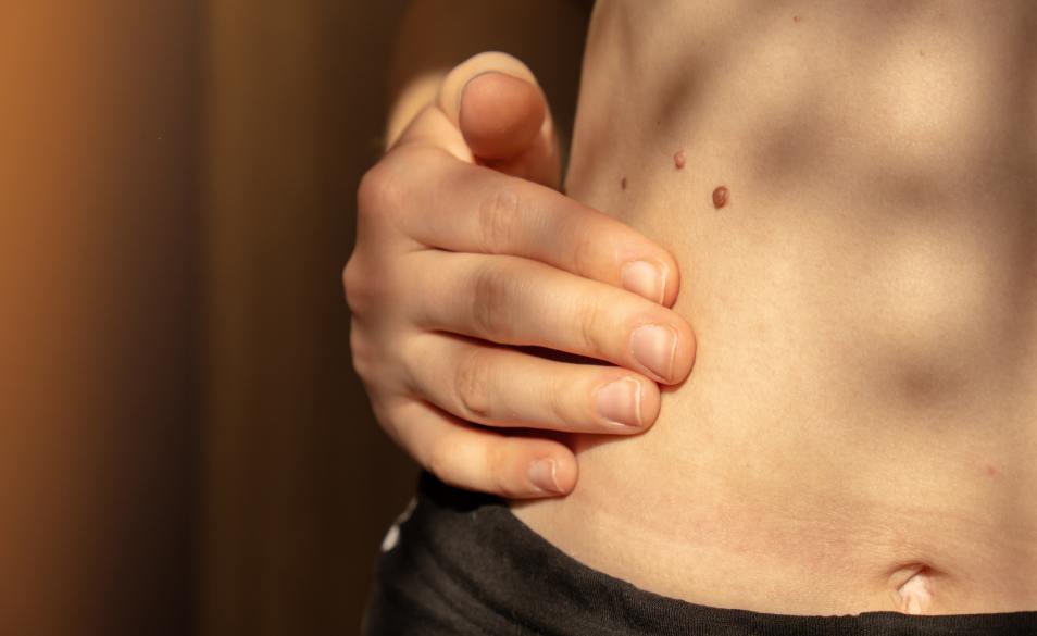 Dark Spots: Causes & Types 