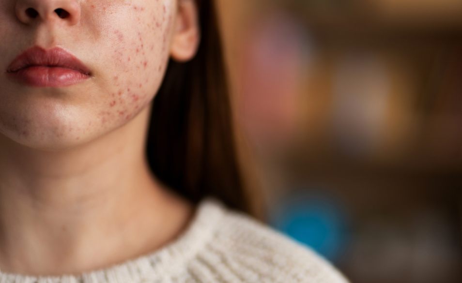 Dark Spots: Effective Treatments