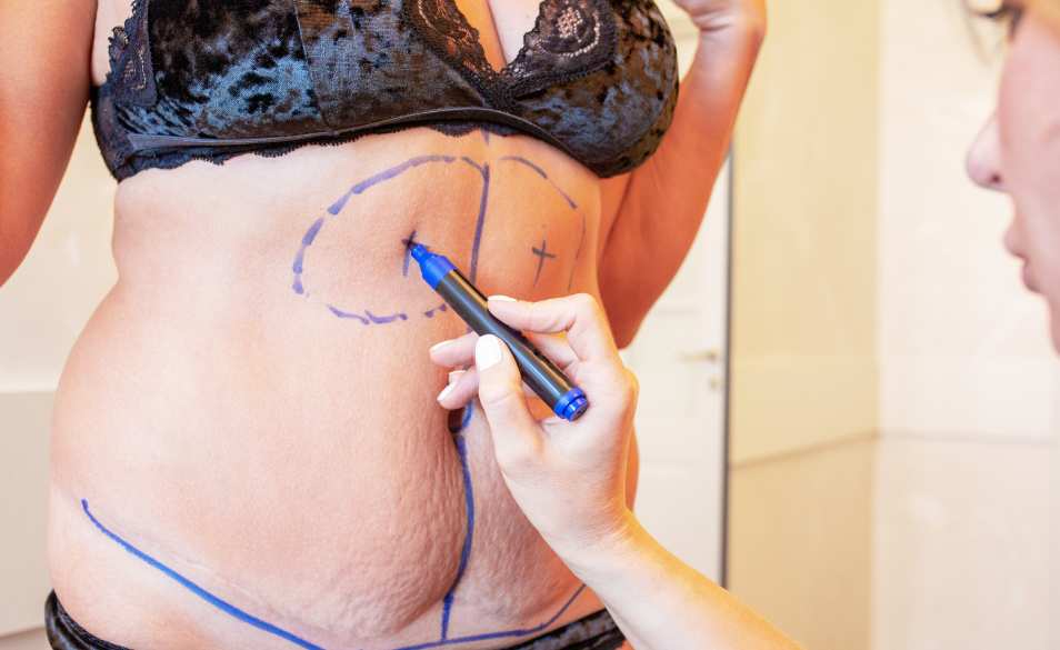 liposuction