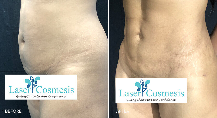 RF Abdominal Contouring