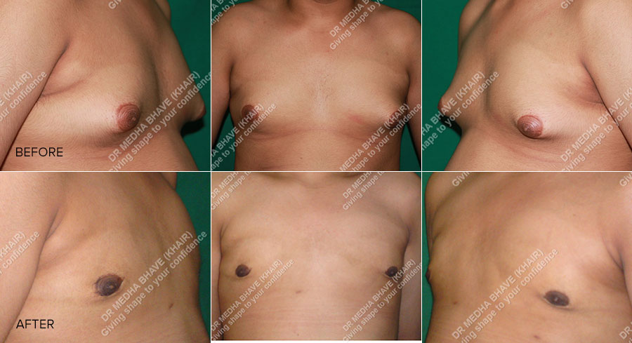 Gynecomastia