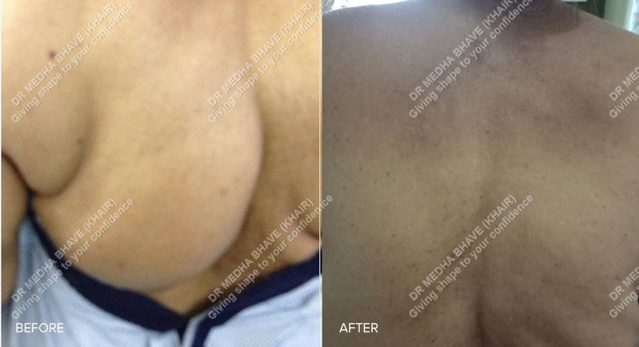 Lipoma