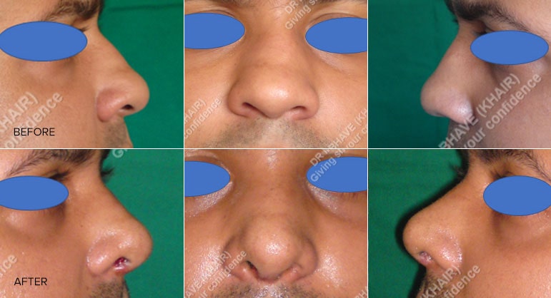 Rhinoplasty Result