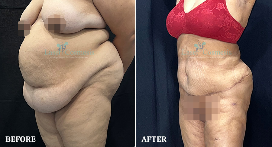 Tummy Tuck