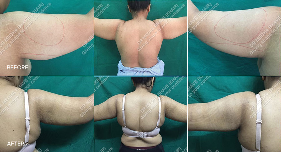 Liposuction High Definition