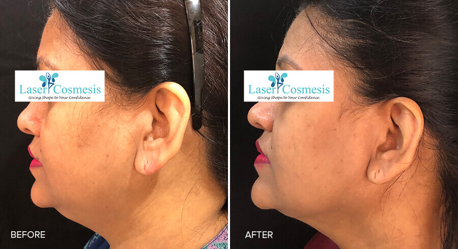 RF Skin Tightening