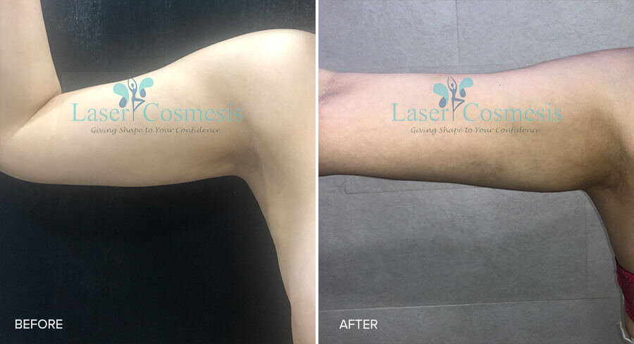 RF Arm Lift