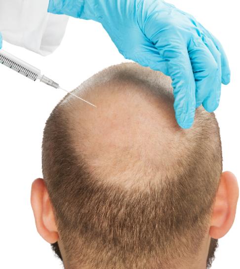 hair transplant